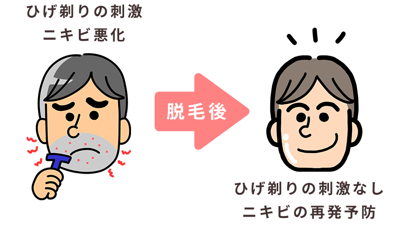 髭剃り、ニキビ予防