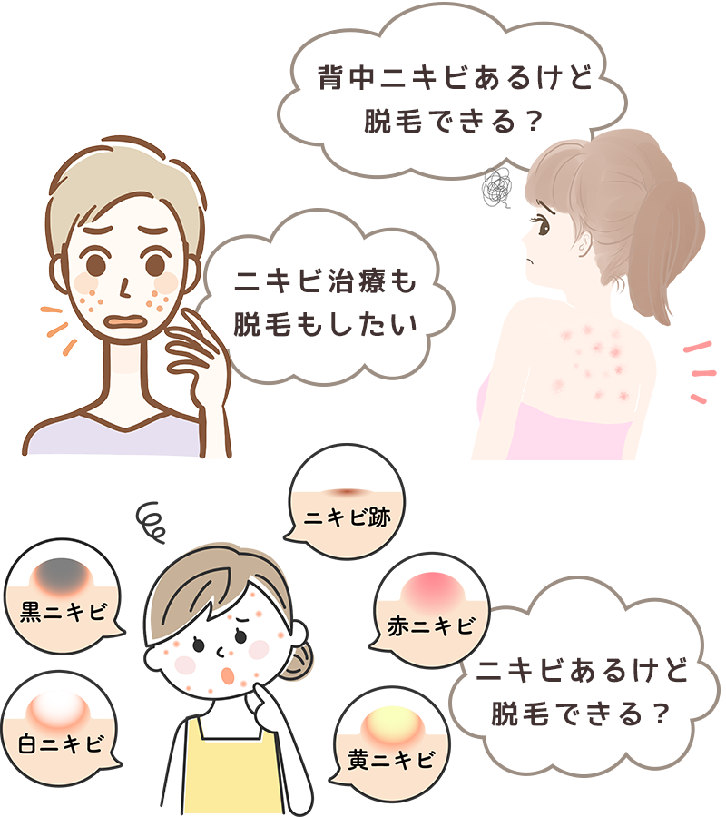 ニキビがあっても脱毛できる？