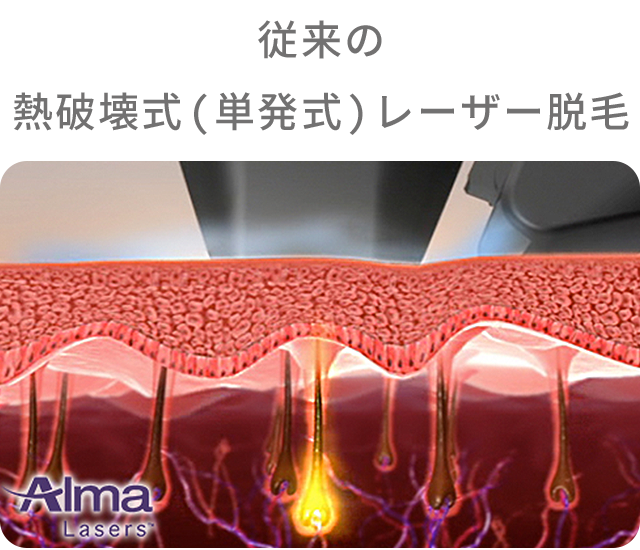 従来の医療レーザー脱毛