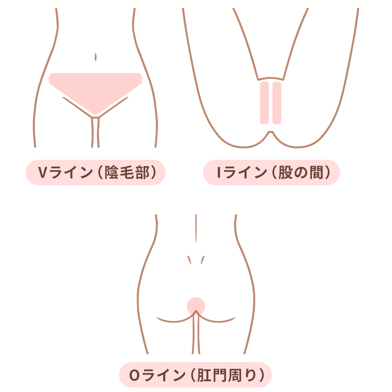 VIO脱毛