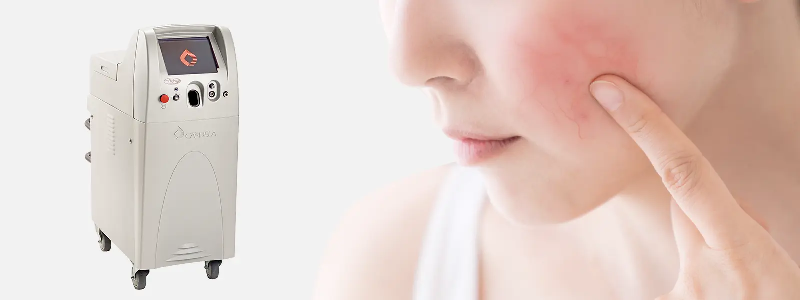 赤ら顔・血管腫