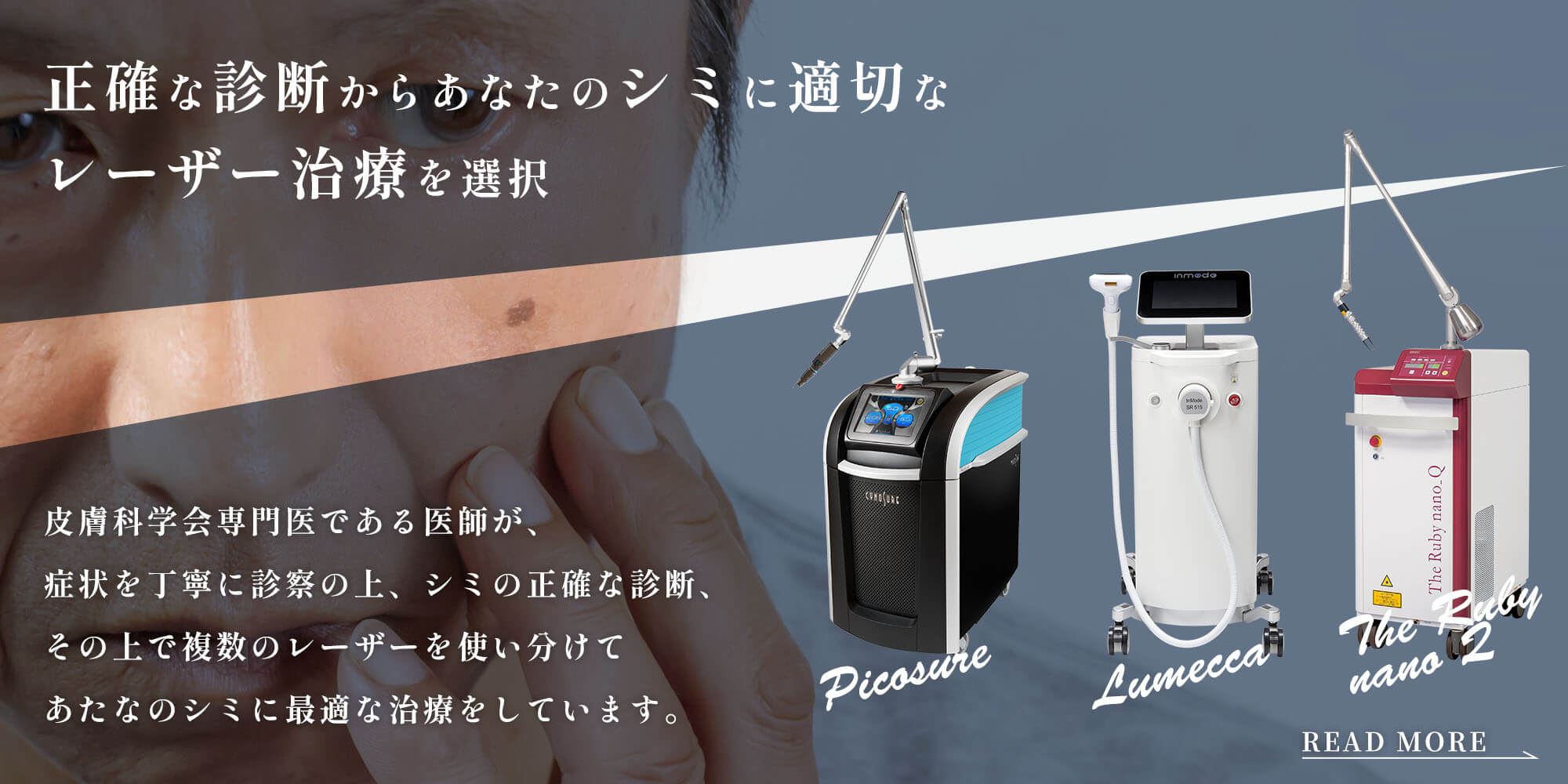 シミ取りレーザー
